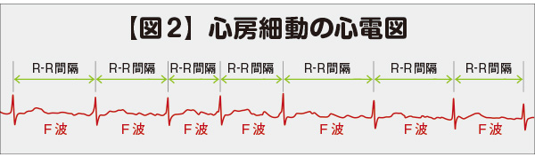 心房細動心電図