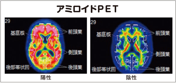 アミロイドＰＥＴ