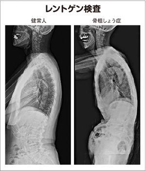 レントゲン検査