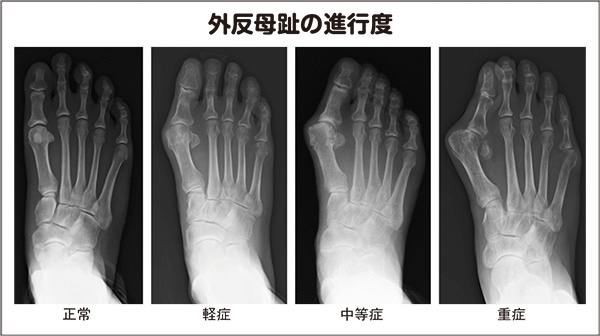 外反母趾の進行度