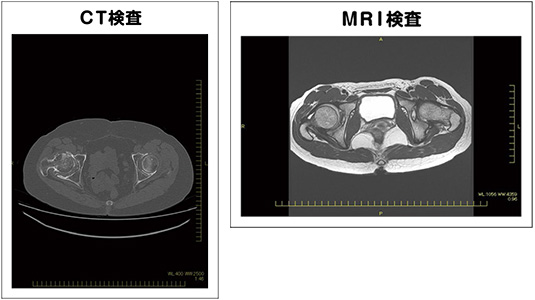 CT検査とMRI検査