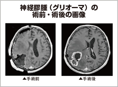 神経膠腫（グリオーマ）の術前・術後の画像