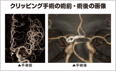 クリッピング手術の術前・術後の画像