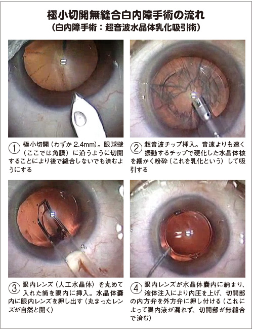白内障手術