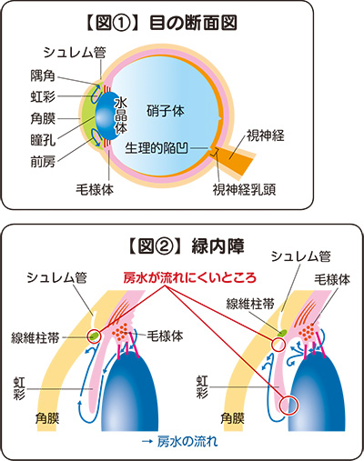 緑内障