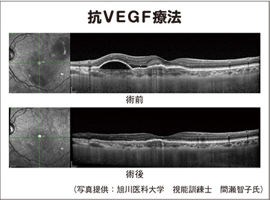 抗ＶＥＧＦ療法